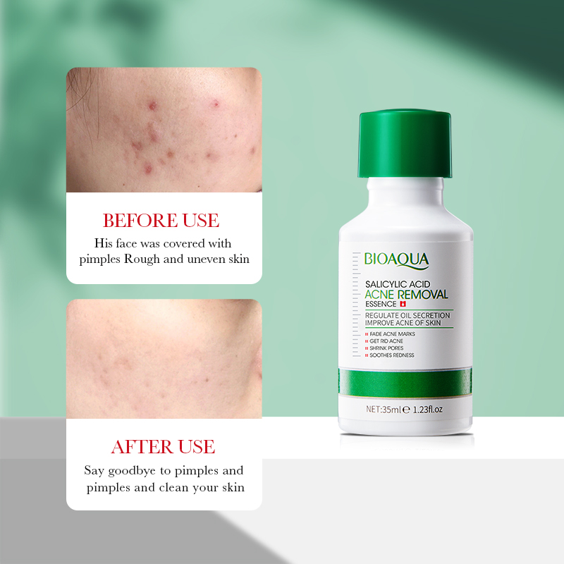 35ml BIOAOUA Salicylic Acid An - огляд і ціна Salicylic Acid Blackhead Remover