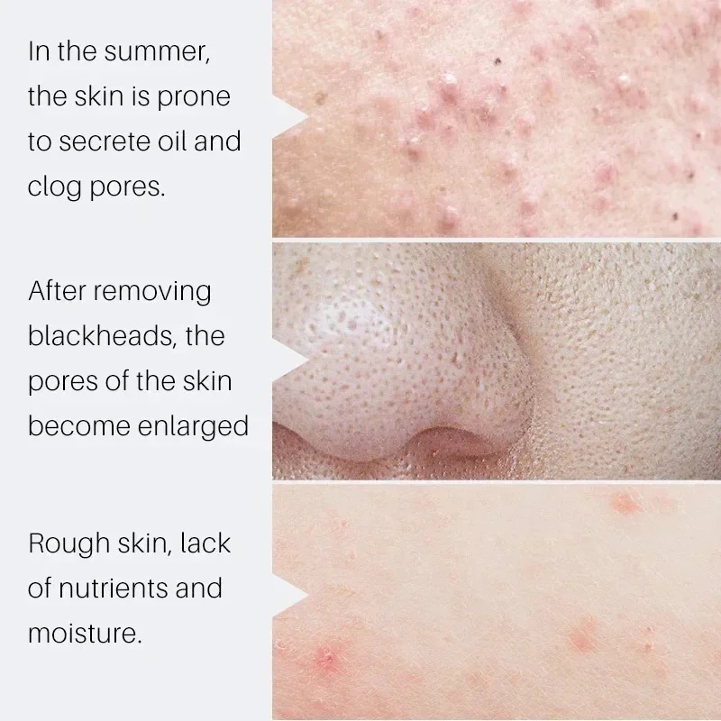 Salicylic Acid Pore Shrinking  - огляд і ціна Salicylic Acid Blackhead Remover